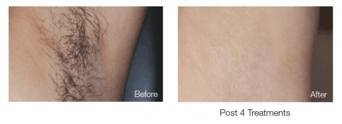 Laser Hair Removal Post