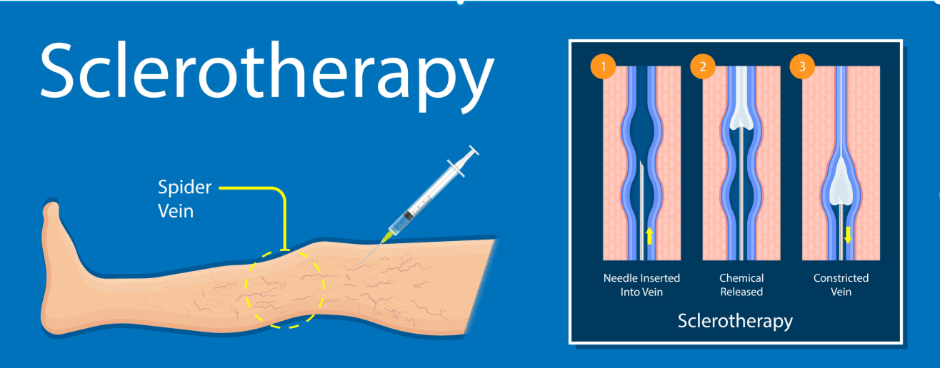 vein clinics sclerotherapy