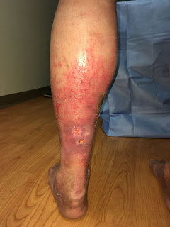 leg swelling