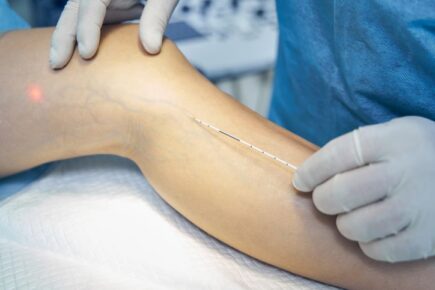WHAT CAUSES VARICOSE VEINS
