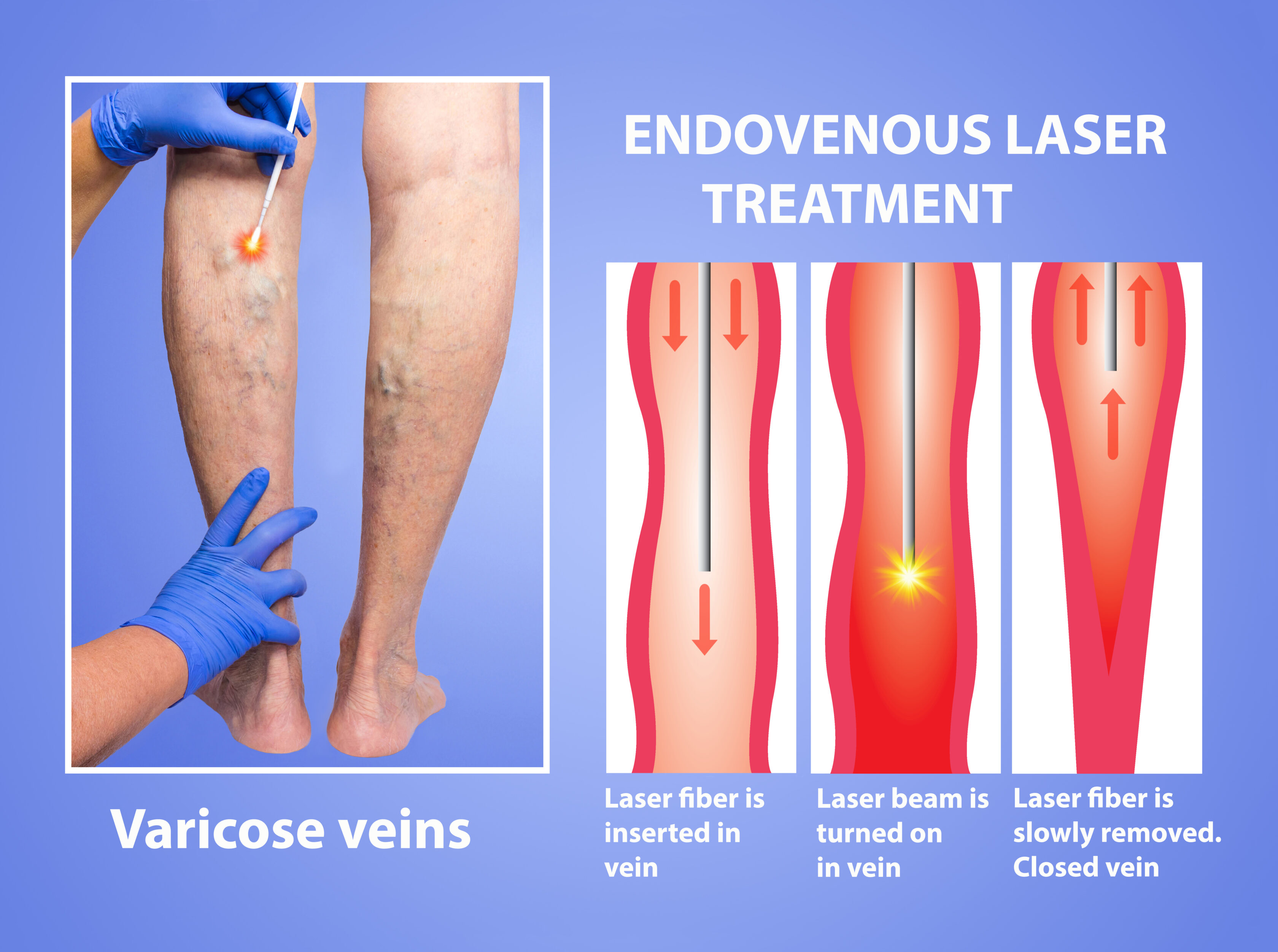 Varicose Veins Laser Treatment